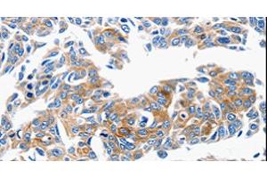 Immunohistochemistry of paraffin-embedded Human lung cancer tissue using CCL6 Polyclonal Antibody at dilution 1:50 (CCL6 Antikörper)