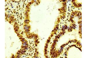 IHC image of ABIN7127297 diluted at 1:100 and staining in paraffin-embedded human colon cancer performed on a Leica BondTM system. (Rekombinanter HIST1H4A Antikörper)