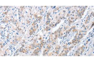 Immunohistochemistry of paraffin-embedded Human gastric cancer tissue using PAPSS1 Polyclonal Antibody at dilution 1:40 (PAPSS1 Antikörper)