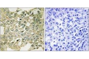 Immunohistochemistry analysis of paraffin-embedded human breast carcinoma, using MYT1 (Phospho-Ser83) Antibody. (MYT1 Antikörper  (pSer83))