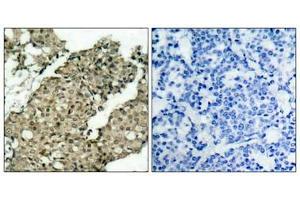 Immunohistochemical analysis of paraffin-embedded human breast carcinoma tissue using G3BP-1(Phospho-Ser232) Antibody(left) or the same antibody preincubated with blocking peptide(right).