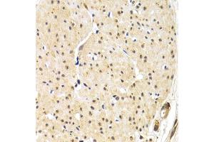 Immunohistochemistry of paraffin-embedded human gastric cancer using TERF1 antibody (ABIN1683138, ABIN3015078, ABIN3015079 and ABIN6213631) at dilution of 1:200 (40x lens). (TRF1 Antikörper  (AA 240-419))