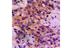 Immunohistochemical analysis of Caspase 2 staining in human breast cancer formalin fixed paraffin embedded tissue section. (Caspase 2 Antikörper  (Center))