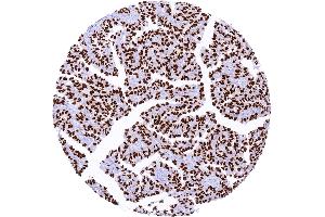 Pulmonary adenocarcinoma with strong TTF1 staining of all tumor cells (Rekombinanter NKX2-1 Antikörper)