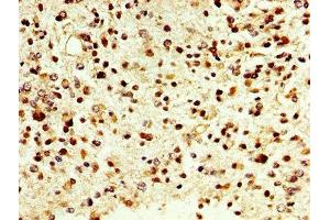 IHC image of ABIN7149450 diluted at 1:500 and staining in paraffin-embedded human glioma cancer performed on a Leica BondTM system. (D Amino Acid Oxidase Antikörper  (AA 1-347))