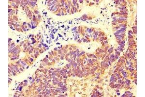 Immunohistochemistry of paraffin-embedded human ovarian cancer using ABIN7169495 at dilution of 1:100 (SH3BP5 Antikörper  (AA 49-455))