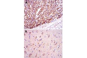 Immunohistochemical analysis of paraffin-embedded human liver cancer tissues (A) and brain tissues (B) using APOE monoclonal antibody, clone 1H4  with DAB staining. (APOE Antikörper)