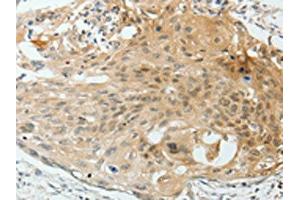 The image on the left is immunohistochemistry of paraffin-embedded Human cervical cancer tissue using ABIN7193012(VEGFA Antibody) at dilution 1/25, on the right is treated with synthetic peptide. (VEGFA Antikörper)