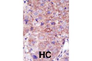 Formalin-fixed and paraffin-embedded human hepatocellular carcinoma tissue reacted with SMURF2 polyclonal antibody  , which was peroxidase-conjugated to the secondary antibody, followed by DAB staining. (SMURF2 Antikörper  (AA 702-731))