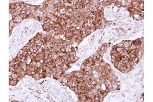 IHC-P Image Immunohistochemical analysis of paraffin-embedded human breast cancer, using FIG4, antibody at 1:500 dilution. (FIG4 Antikörper  (Center))