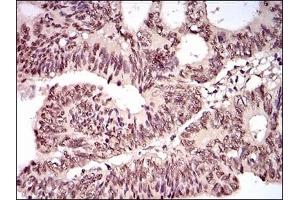 Immunohistochemical analysis of paraffin-embedded human rectum cancer tissues using TBLR1 mouse mAb with DAB staining. (TBL1XR1 Antikörper)