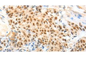 Immunohistochemistry of paraffin-embedded Human esophagus cancer using APPL1 Polyclonal Antibody at dilution of 1:70