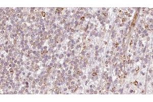 ABIN6273204 at 1/100 staining Human lymph cancer tissue by IHC-P. (CALCOCO2 Antikörper  (Internal Region))