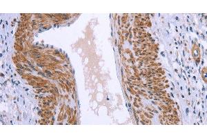Immunohistochemistry of paraffin-embedded Human cervical cancer tissue using GNPAT Polyclonal Antibody at dilution 1:40 (GNPAT Antikörper)