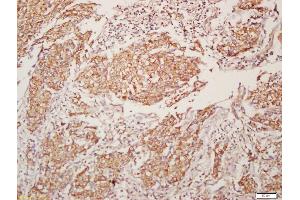 Formalin-fixed and paraffin embedded human lung carcinoma labeled with Anti-CHRM4/mAChR M4 Polyclonal Antibody, Unconjugated (ABIN1387838) at 1:200, followed by conjugation to the secondary antibody and DAB staining