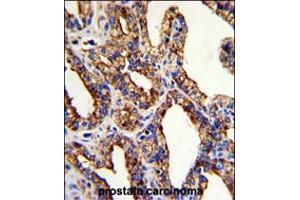 Formalin-fixed and paraffin-embedded human prostate carcinoma with TROP2 Antibody , which was peroxidase-conjugated to the secondary antibody, followed by DAB staining. (TACSTD2 Antikörper  (AA 162-190))