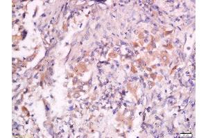 Formalin-fixed and paraffin embedded human lung carcinoma labeled with Anti- Pan FOXD Polyclonal Antibody, Unconjugated  at 1:200 followed by conjugation to the secondary antibody and DAB staining. (FOXD (AA 131-230) Antikörper)