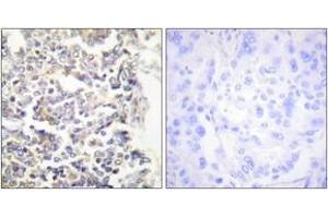 Immunohistochemistry analysis of paraffin-embedded human lung carcinoma tissue, using MARK3 Antibody.