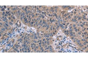 Immunohistochemistry of paraffin-embedded Human lung cancer using p53RFP Polyclonal Antibody at dilution of 1:50 (RNF144B Antikörper)