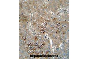 CES4 antibody (N-term) immunohistochemistry analysis in formalin fixed and paraffin embedded human hepatocarcinoma followed by peroxidase conjugation of the secondary antibody and DAB staining. (CES1P1 Antikörper  (N-Term))