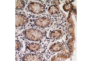 Immunohistochemical analysis of Villin staining in human colon cancer formalin fixed paraffin embedded tissue section. (Villin 1 Antikörper)