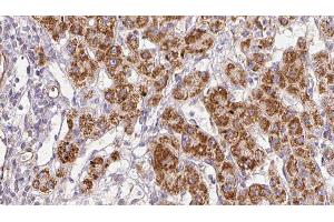 ABIN6278853 at 1/100 staining Human liver cancer tissue by IHC-P. (CALY Antikörper  (Internal Region))