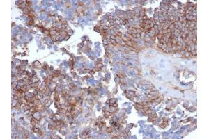 Formalin-fixed, paraffin-embedded human ovarian carcinoma stained with N-Cadherin Recombinant Rabbit Monoclonal Antibody (CDH2/6857R). (Rekombinanter N-Cadherin Antikörper)