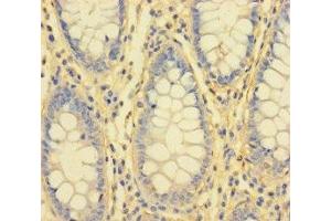 Immunohistochemistry of paraffin-embedded human colon cancer using ABIN7156759 at dilution of 1:100 (IL1RL2 Antikörper  (AA 20-218))
