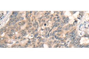 Immunohistochemistry of paraffin-embedded Human liver cancer tissue using BBOX1 Polyclonal Antibody at dilution of 1:45(x200) (BBOX1 Antikörper)