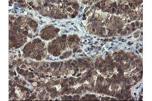 Immunohistochemical staining of paraffin-embedded Adenocarcinoma of Human ovary tissue using anti-MLF1 mouse monoclonal antibody. (MLF1 Antikörper)