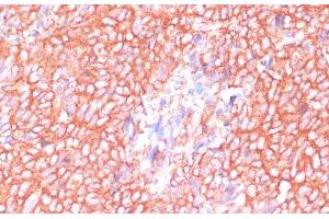 Immunohistochemistry of paraffin-embedded Human oophoroma using MOB4 Polyclonal Antibody at dilution of 1:100 (40x lens).