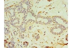 Immunohistochemistry of paraffin-embedded human breast cancer using ABIN7152819 at dilution of 1:100 (FGF6 Antikörper  (AA 38-208))