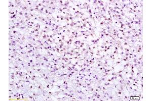 Formalin-fixed and paraffin embedded human gastric carcinoma labeled with Anti CHK2 Polyclonal Antibody, Unconjugated (ABIN685867) at 1:200 followed by conjugation to the secondary antibody and DAB staining