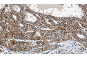ABIN6269254 at 1/100 staining Human liver cancer tissue by IHC-P.