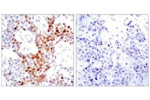 Immunohistochemical analysis of paraffin-embedded human breast carcinoma tissue using ATF2(Phospho-Thr69 or 51) Antibody(left) or the same antibody preincubated with blocking peptide(right). (ATF2 Antikörper  (pThr69))