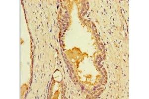 Immunohistochemistry of paraffin-embedded human prostate cancer using ABIN7158346 at dilution of 1:100