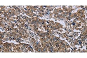 Immunohistochemistry of paraffin-embedded Human liver cancer using GGCX Polyclonal Antibody at dilution of 1:50