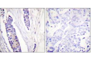 Immunohistochemistry analysis of paraffin-embedded human breast carcinoma tissue, using Tubulin beta antibody. (TUBB Antikörper  (C-Term))