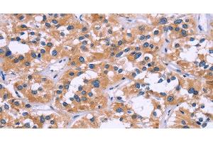 Immunohistochemistry of paraffin-embedded Human thyroid cancer tissue using ZEB2 Polyclonal Antibody at dilution 1:60