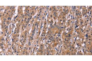 Immunohistochemistry of paraffin-embedded Human gastric cancer using SEPT7 Polyclonal Antibody at dilution of 1:50 (Septin 7 Antikörper)