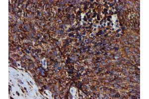 Immunohistochemical staining of paraffin-embedded Adenocarcinoma of Human breast tissue using anti-PDIA4 mouse monoclonal antibody. (PDIA4 Antikörper)
