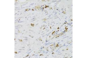 Immunohistochemistry of paraffin-embedded human adenomyosis using LSP1 Antibody (ABIN5973271) at dilution of 1/100 (40x lens). (LSP1 Antikörper)