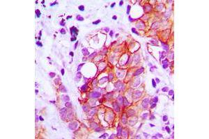 Immunohistochemical analysis of GAD1/2 staining in human breast cancer formalin fixed paraffin embedded tissue section. (GAD65+GAD67 (C-Term) Antikörper)