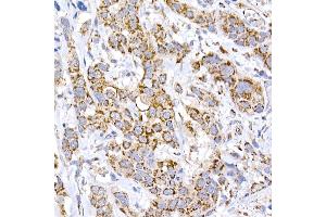 Immunohistochemistry of paraffin-embedded human esophageal cancer using MRPS15 Rabbit mAb (ABIN7268582) at dilution of 1:250 (40x lens). (MRPS15 Antikörper)