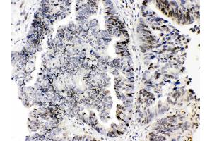 E2F4 was detected in paraffin-embedded sections of human intetsinal cancer tissues using rabbit anti- E2F4 Antigen Affinity purified polyclonal antibody (Catalog # ) at 1 µg/mL.