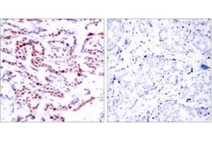 Immunohistochemistry analysis of paraffin-embedded human breast carcinoma, using ATF2 (Phospho-Ser112 or 94) Antibody. (ATF2 Antikörper  (pSer112))