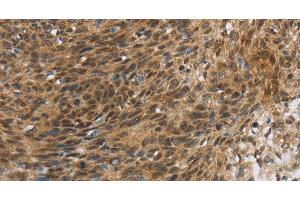 Immunohistochemistry of paraffin-embedded Human cervical cancer tissue using FOXB1 Polyclonal Antibody at dilution 1:30 (FOXB1 Antikörper)