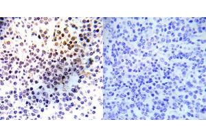 Immunohistochemical analysis of paraffin- embedded human malignant lymphoma tissue using Histone H3. (Histone H3.1 Antikörper)