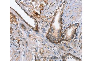 Immunohistochemistry of Human prostate cancer using MAD2L1BP Polyclonal Antibody at dilution of 1:65 (MAD2L1BP Antikörper)