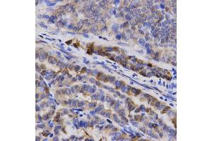 Immunohistochemistry of paraffin-embedded human thyroid cancer using SNCG antibody at dilution of 1:200 (x400 lens) (SNCG Antikörper  (AA 1-127))